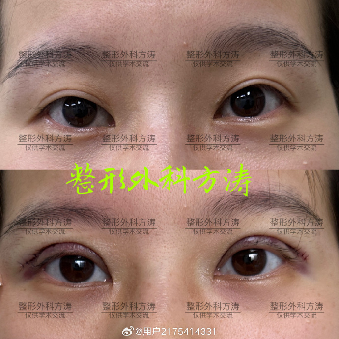 方濤雙眼皮修復案例