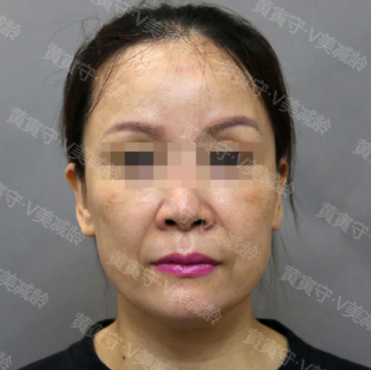 黃寅守面部拉皮案例