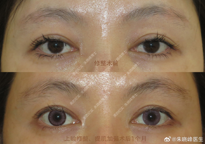 北京雙眼皮修復哪個醫生好