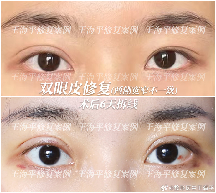 王海平雙眼皮修復案例