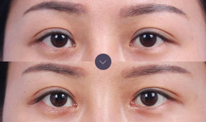 北京雙眼皮修復最厲害醫生是哪個？