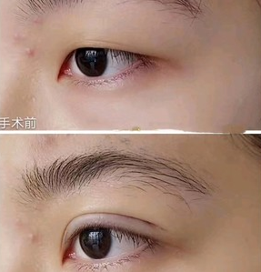沈陽楊慶峰雙眼皮修復技術(shù)怎么樣