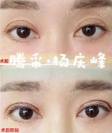 楊慶峰雙眼皮修復案例
