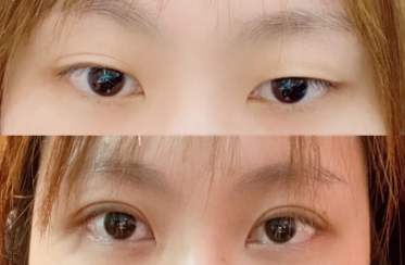 杭州雙眼皮修復最好的醫(yī)生是哪個