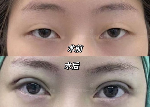 郭國祥做雙眼皮案例