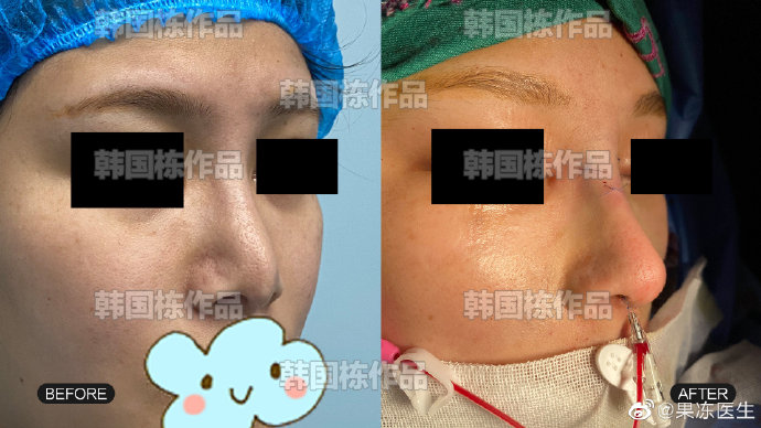韓國棟鼻修復案例