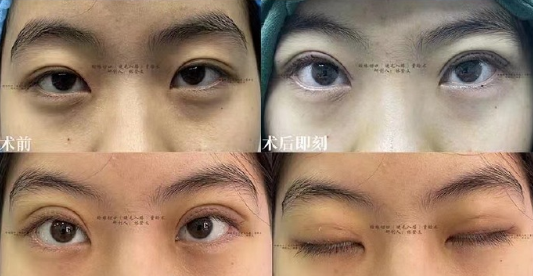 林登文雙眼皮修復案例