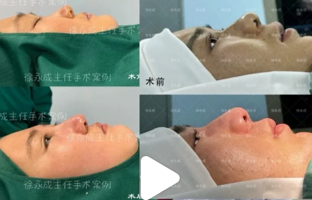 徐永成鼻修復案例