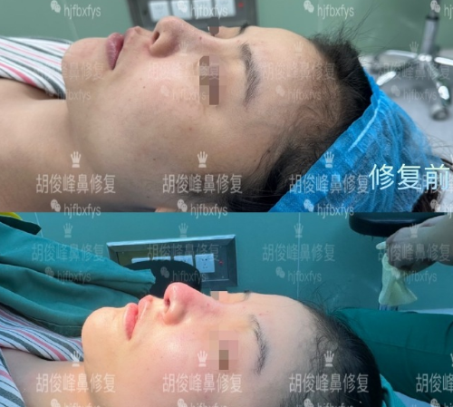 胡俊峰鼻修復案例