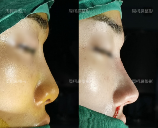 成都鼻修復(fù)哪個(gè)醫(yī)生技術(shù)好？周柯、倪云志、韓國(guó)棟？