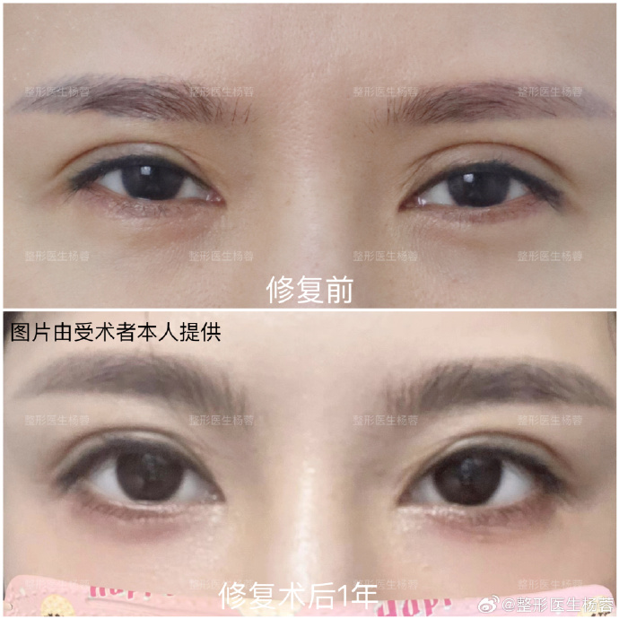 楊蓉雙眼皮修復案例