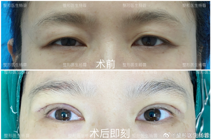 楊蓉雙眼皮案例
