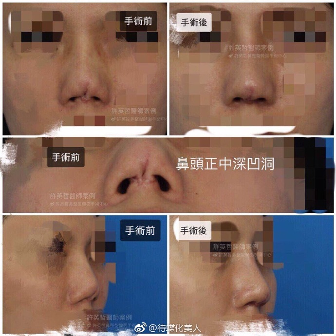 許英哲鼻修復(fù)案例