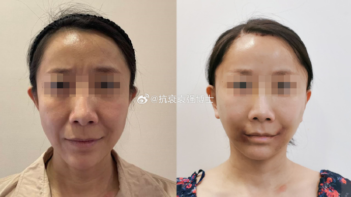 袁強拉皮案例