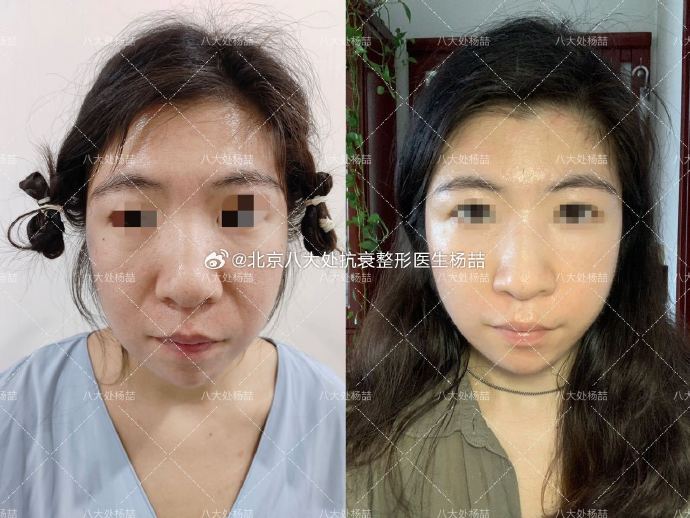 楊喆拉皮手術案例