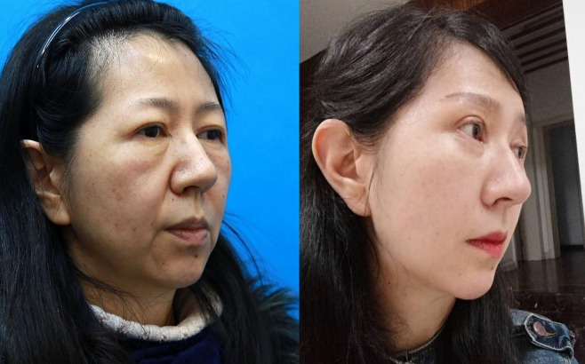丁偉面部拉皮案例