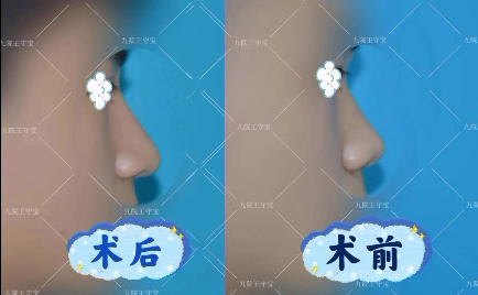 王守寶鼻綜合案例