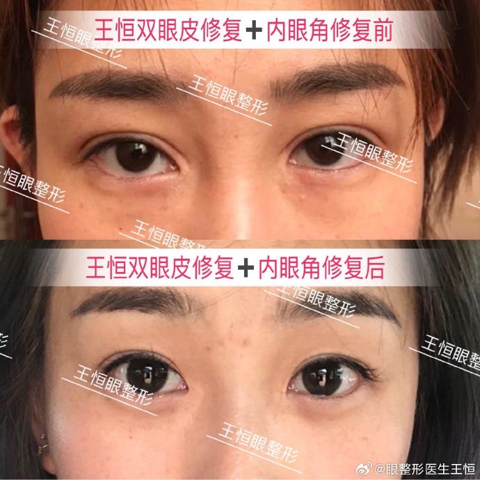 王恒內眼角修復案例