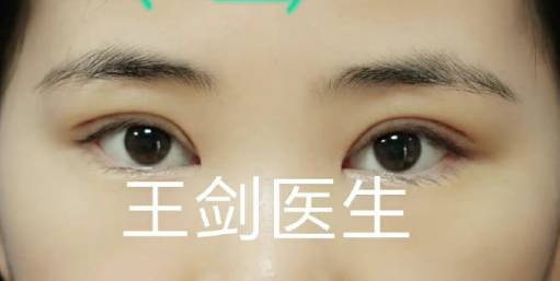 王劍雙眼皮案例