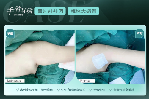 曾志權(quán)手臂吸脂案例