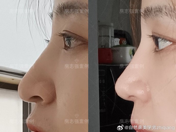 房志強(qiáng)鼻綜合案例