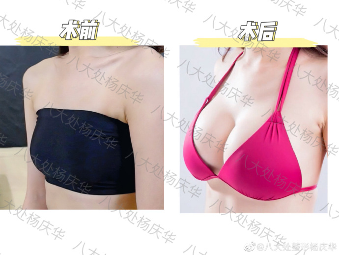 楊慶華豐胸案例
