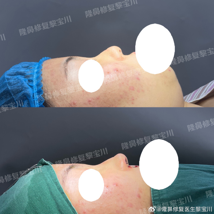 黎寶川鼻綜合案例