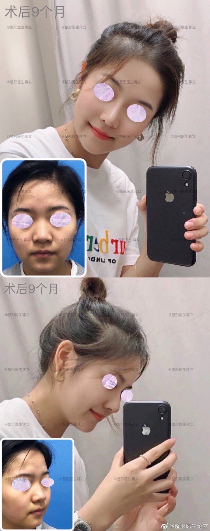 蔣立鼻修復案例