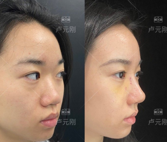 成都哪個鼻子做的好？盧元剛、黃開亮、卿勇、倪云志、鄧東偉？