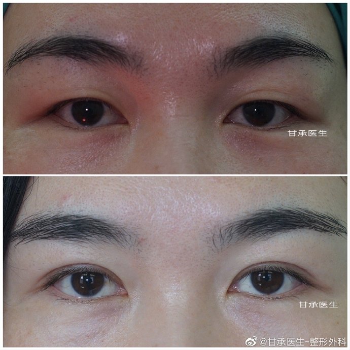 甘承雙眼皮案例