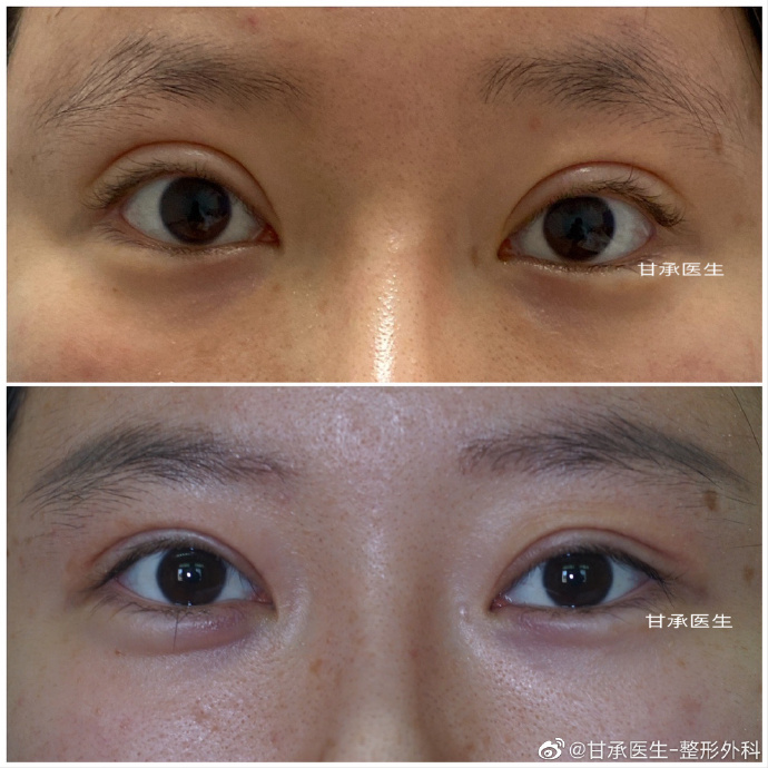 甘承雙眼皮修復案例