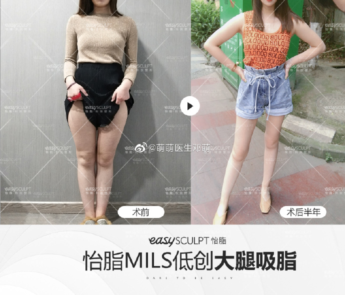 鄧萌吸脂案例