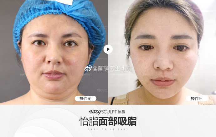 鄧萌吸脂案例