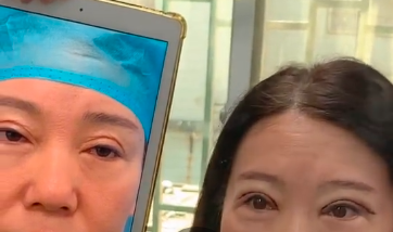 何文星眼修復案例