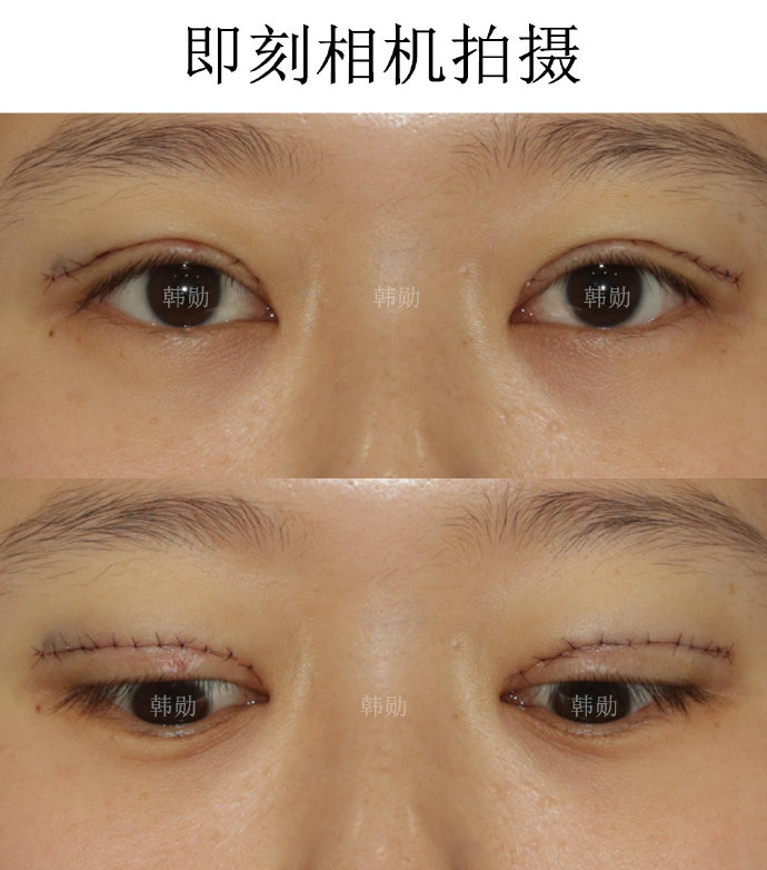 國內(nèi)比較火的雙眼皮醫(yī)生和雙眼皮修復(fù)醫(yī)生