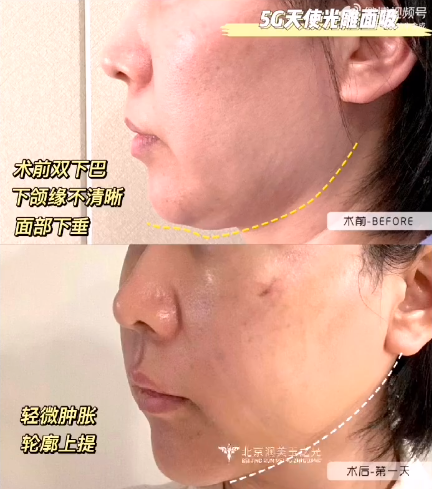 自體脂肪填充臉部