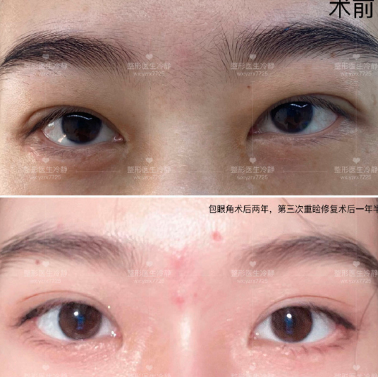 冷靜雙眼皮案例