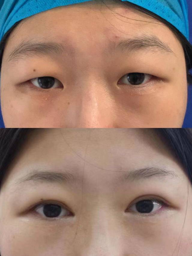 程麗英做雙眼皮案例
