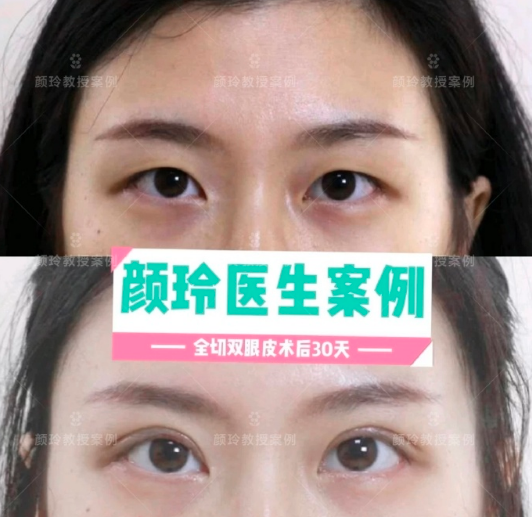 顏玲雙眼皮案例
