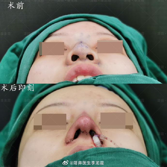 李龍霞鼻修復(fù)案例
