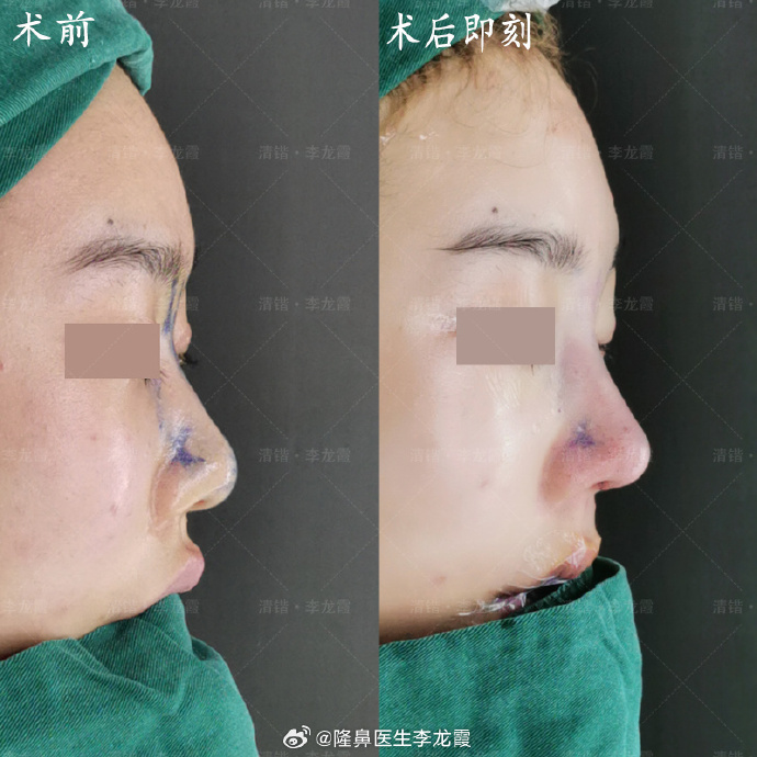 李龍霞鼻綜合案例
