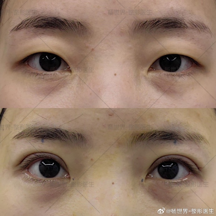 楊世界雙眼皮案例