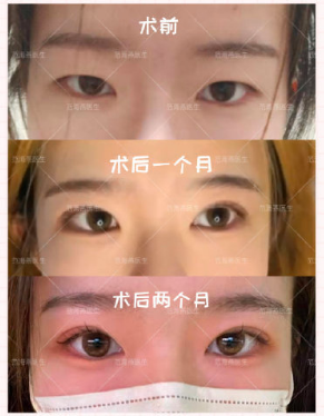 范海燕雙眼皮案例
