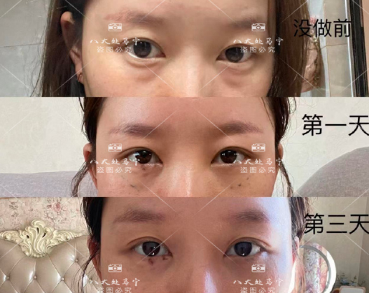 馬寧雙眼皮案例