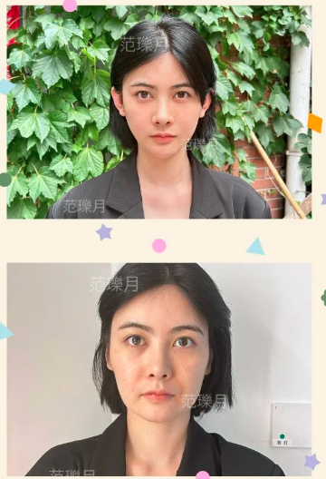 范醫(yī)生輪廓固定案例