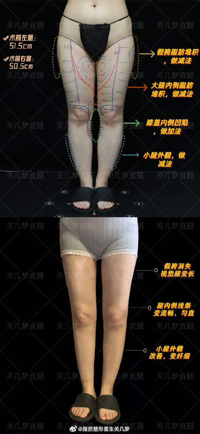 關醫生直腿案例