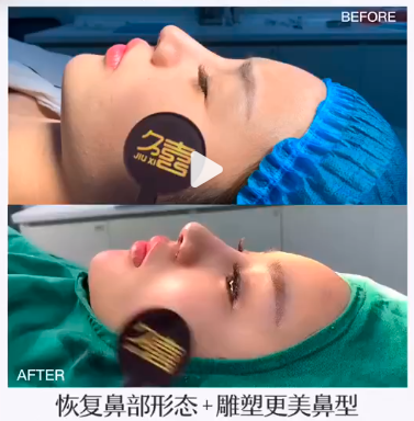 王擊進隆鼻案例