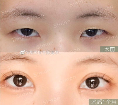 陳海華雙眼皮案例