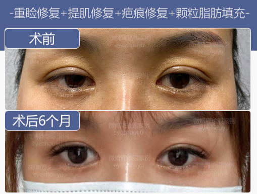周瑜雙眼皮修復案例