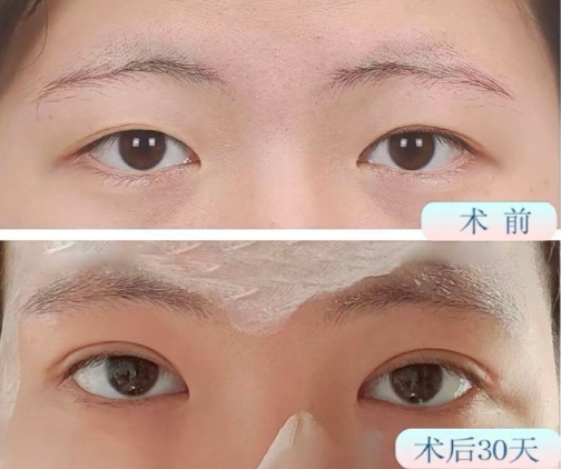 黃蟬雙眼皮案例
